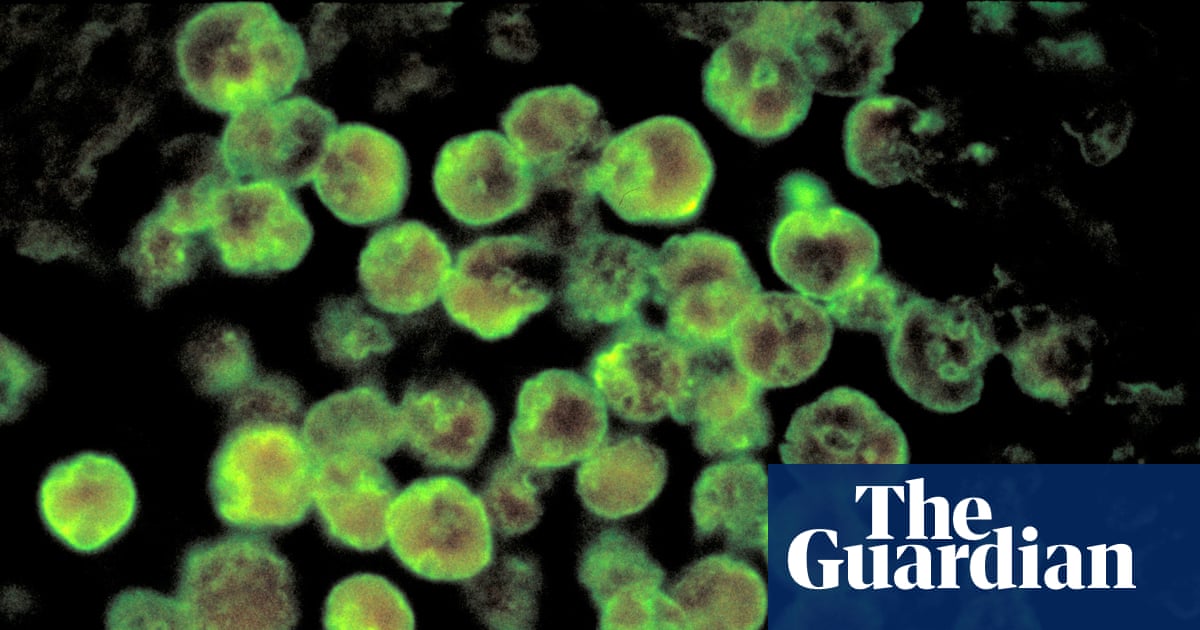 North Carolina teenager dies from rare infection caused by brain-eating amoeba