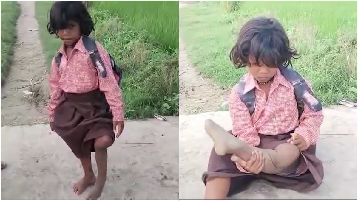UP girl, 7, hops 400 metre to school on 1 leg; gets tricycles, aid after viral video