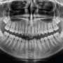 Biodegradable 'nanobone' could one day help regrow bone without painful grafts