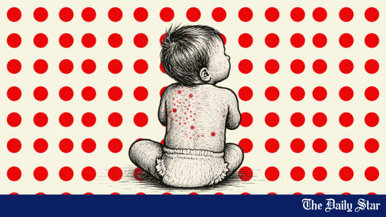 Five more die with measles-like symptoms – The Daily Star